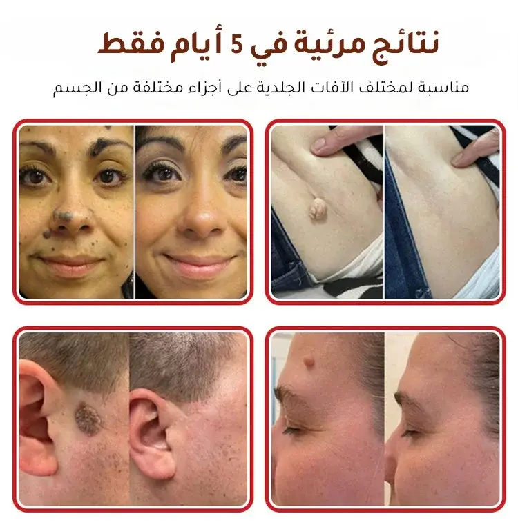 لصقات طبية فعّالة لإزالة الثآليل من الجسم بدون ألم